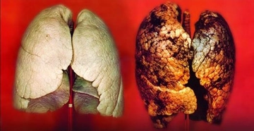 Akciğer Temizleme Kürü Kullanımı ve Faydaları Nelerdir?