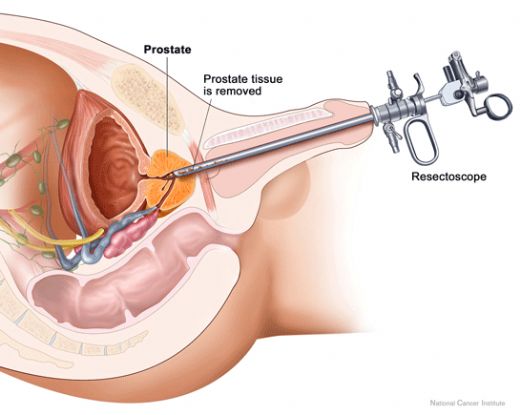 Prostat Kr